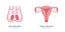 Male and female sterilizations